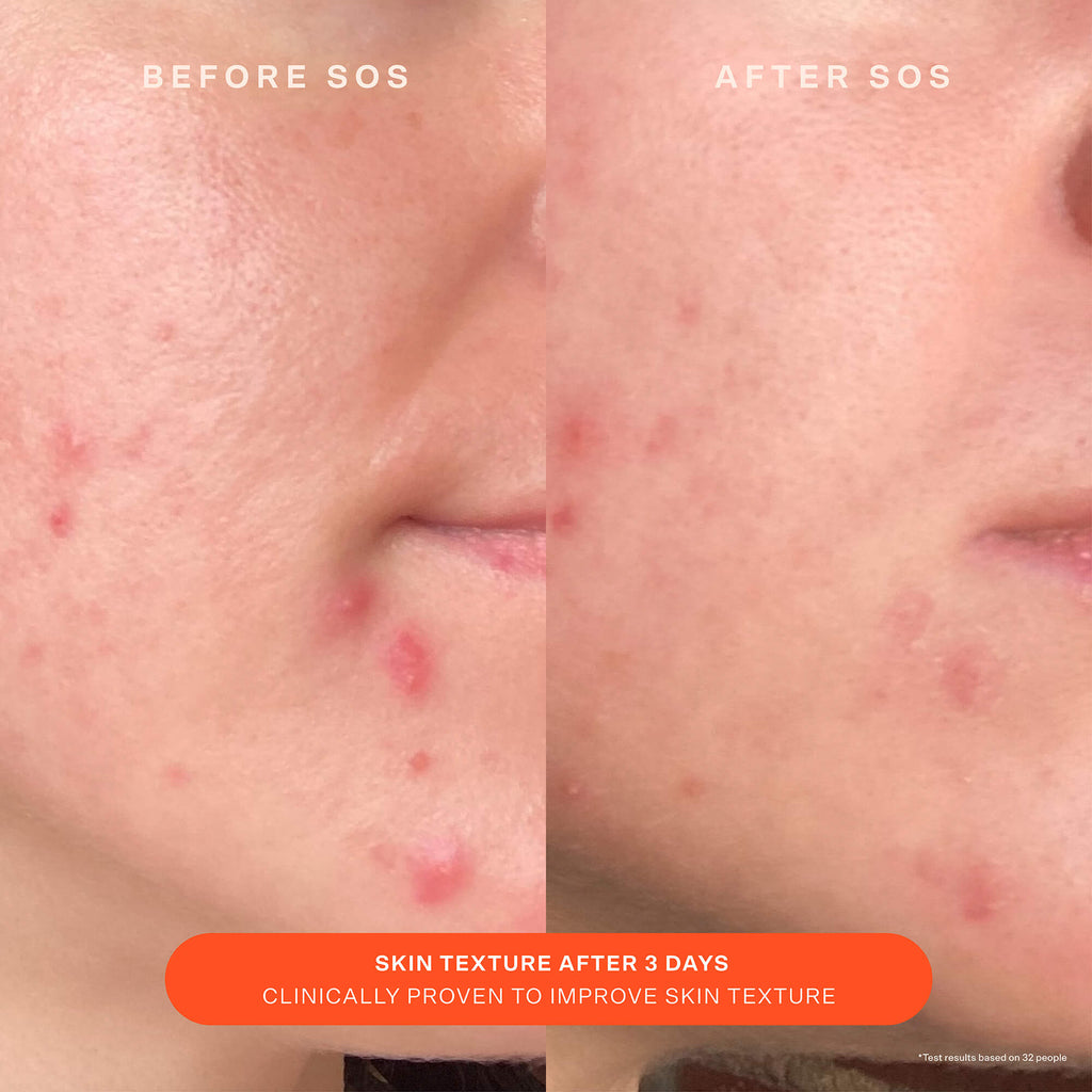 SOS Recovery Cream
